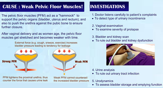 Stress Urinary Incontinence